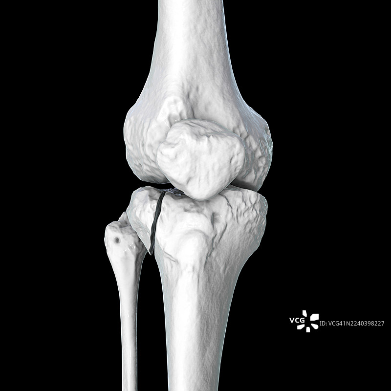 胫骨平台骨折 Schatzker I 型，插画图片素材