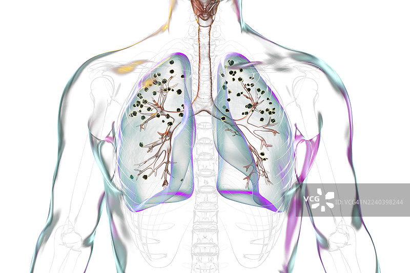 硅肺病变影响的肺部，插画图片素材