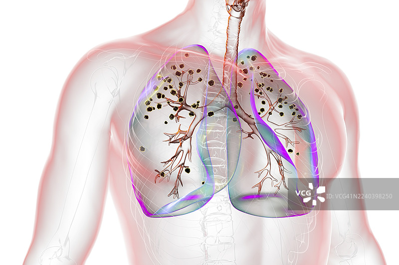 矽肺病受累的肺部，插画图片素材