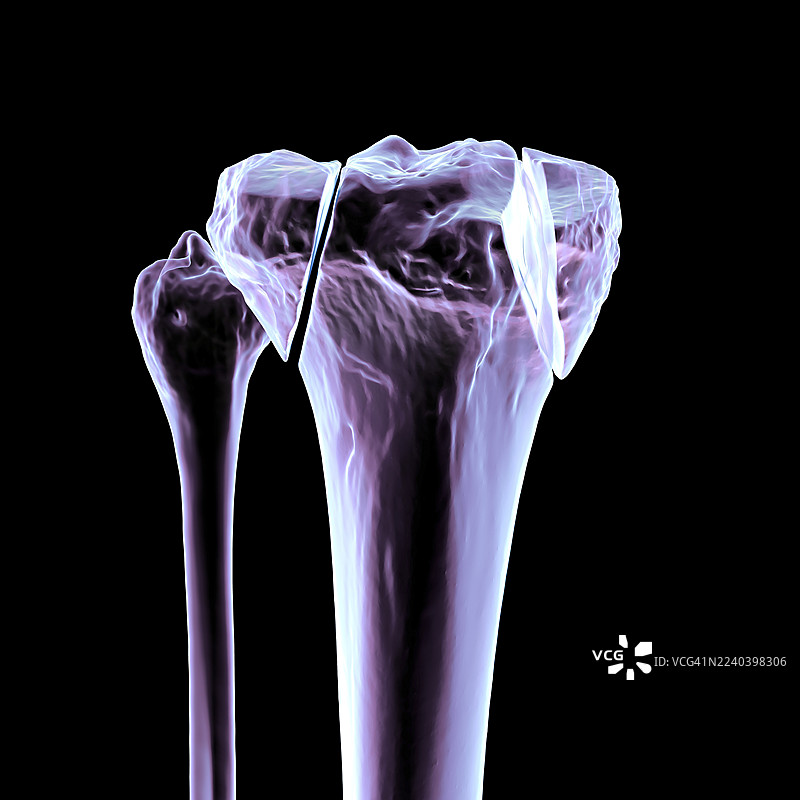 胫骨骨折 Schatzker V 型，插画图片素材