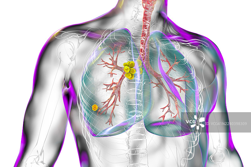 原发性肺结核，插画图片素材