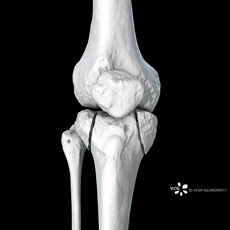 胫骨骨折 Schatzker V型，插画图片素材