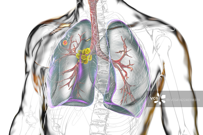 原发性肺结核，插画图片素材