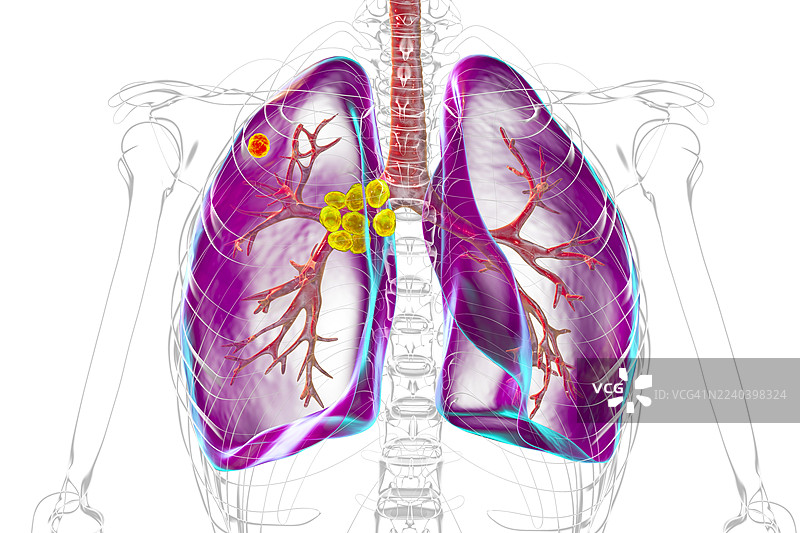 原发性肺结核，插画图片素材