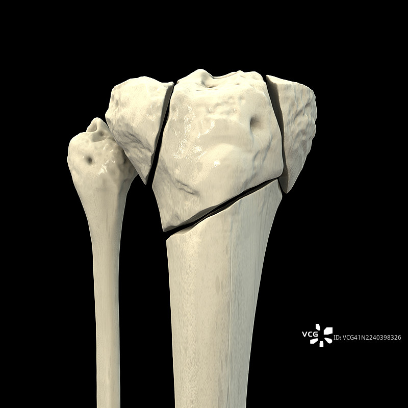 胫骨平台骨折 Schatzker VI 型，插画图片素材