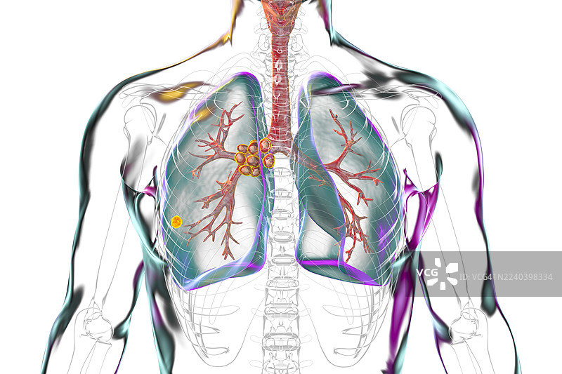 原发性肺结核伴兰氏复合体，插画图片素材