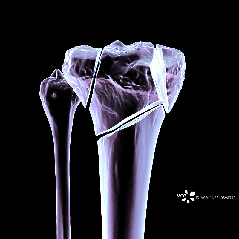 胫骨平台骨折 Schatzker VI 型，插画图片素材