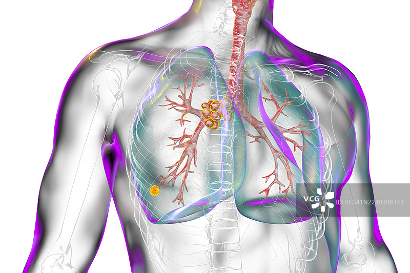 继发性肺结核伴兰氏复合体，插画图片素材
