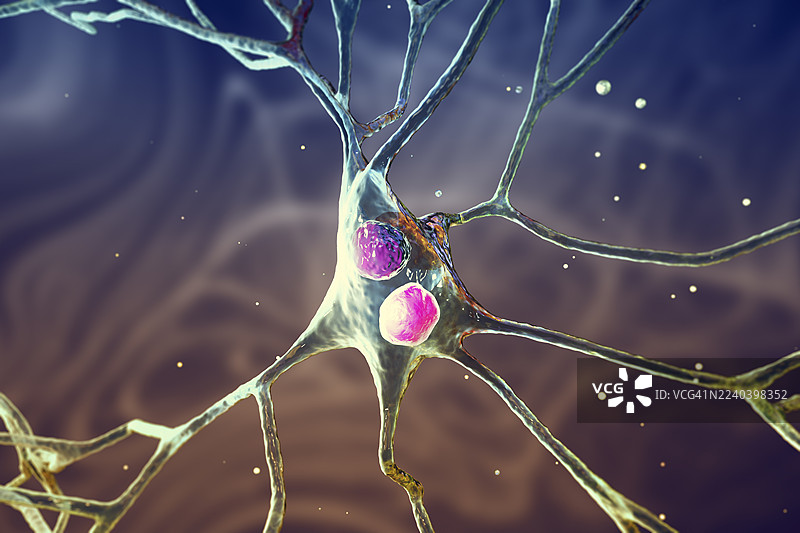 路易体失智症，插画图片素材