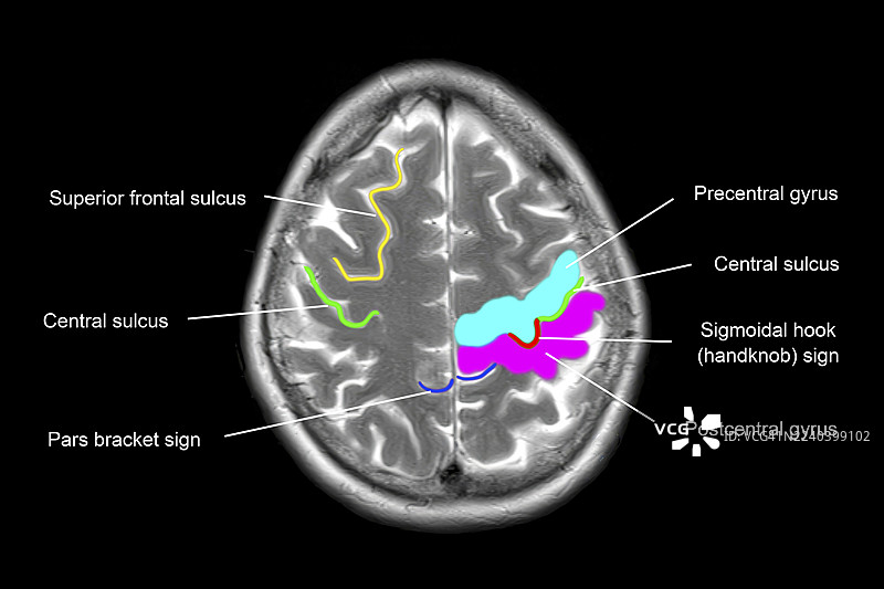 正常的大脑解剖结构，MRI扫描图片素材