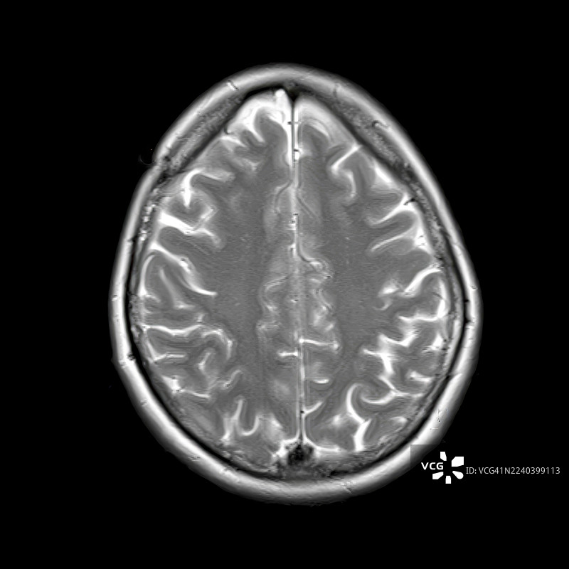 正常大脑解剖结构，MRI扫描图片素材