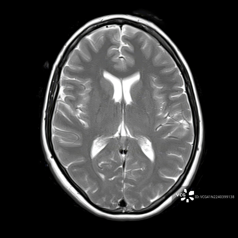 正常大脑解剖，核磁共振成像扫描图片素材