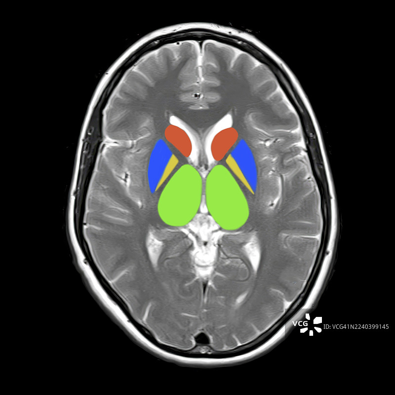 正常大脑解剖结构，MRI扫描图片素材