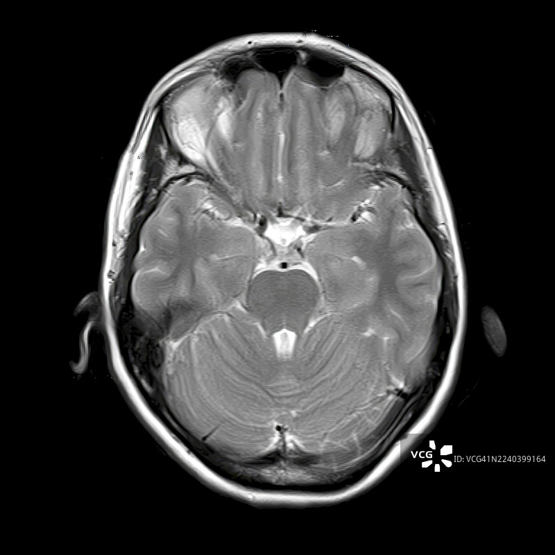 正常大脑解剖结构，MRI扫描图片素材