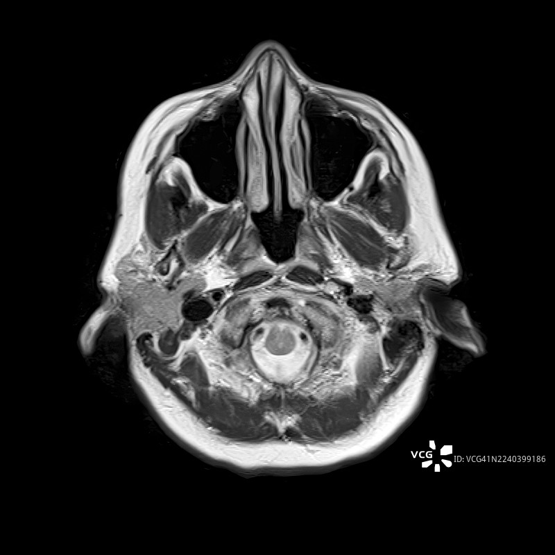 Normal brain anatomy, MRI scan图片素材