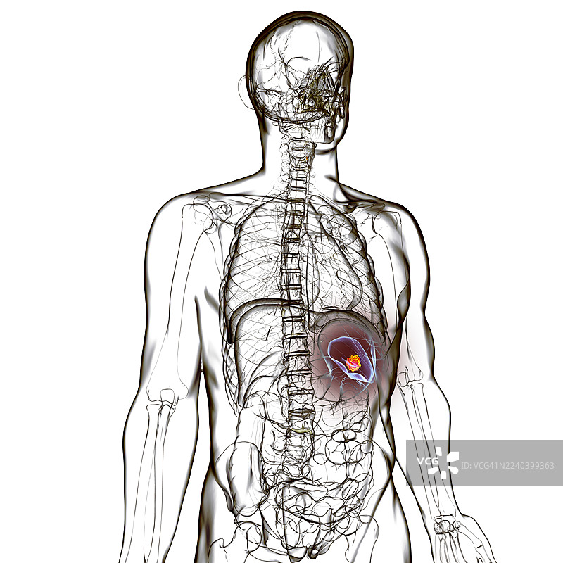 脾癌，插画图片素材