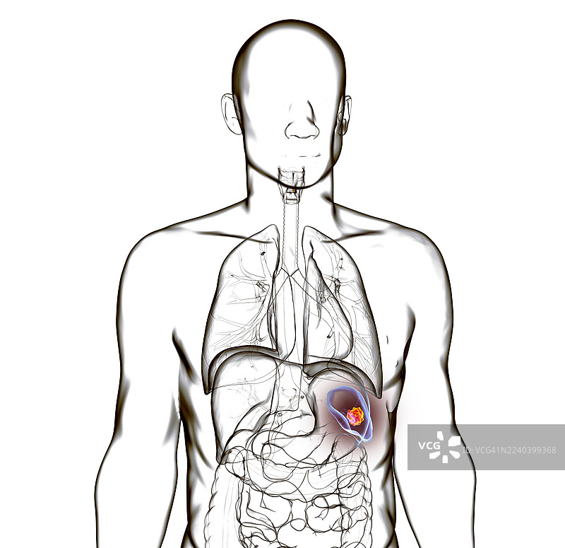 脾脏癌，插画图片素材
