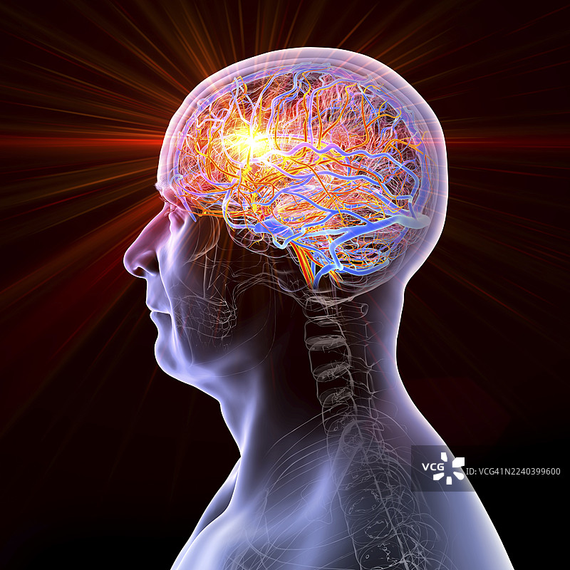脑卒中，概念插画图片素材