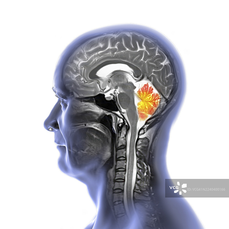 小脑MRI扫描，插画图片素材