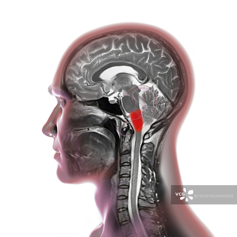 延髓 MRI 扫描图，插画图片素材