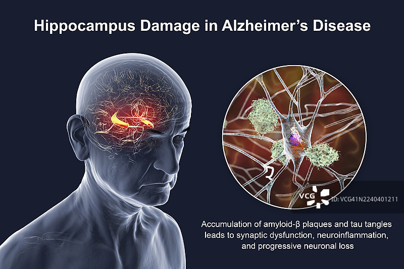 阿尔茨海默病，插画图片素材