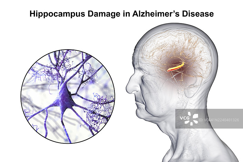 阿尔茨海默病，插画图片素材