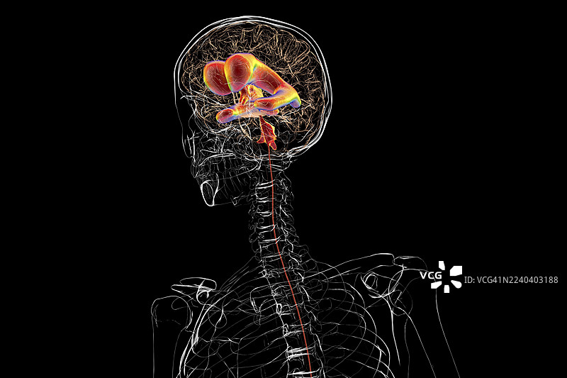 正常压力脑积水，插画图片素材