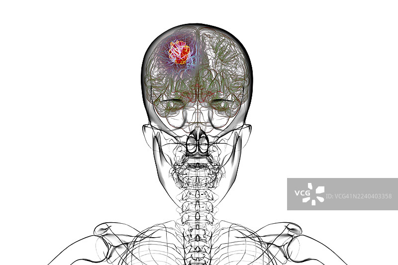 脑肿瘤，插画图片素材