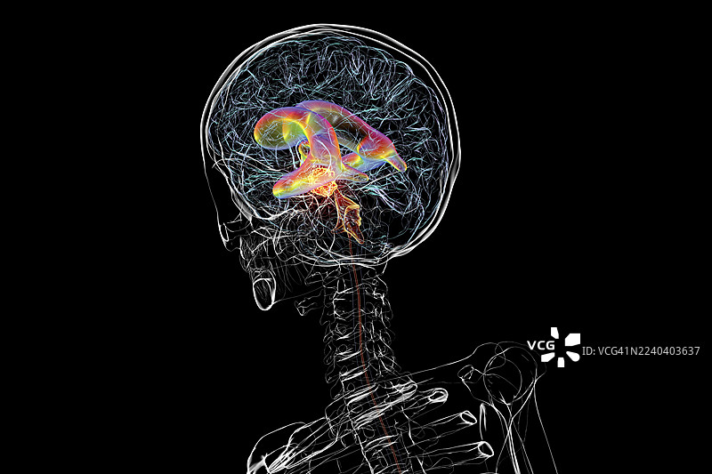 脑肿瘤引起脑积水，插画图片素材