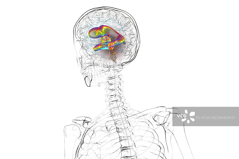 脑肿瘤引起脑积水，插画图片素材
