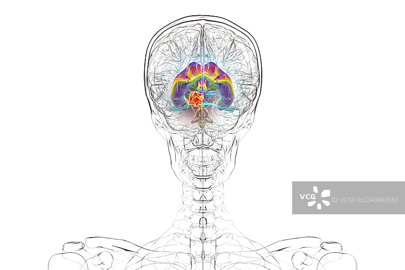 脑部肿瘤引起脑积水，插画图片素材