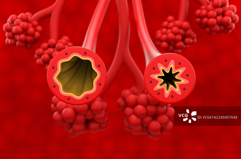 肺部正常和哮喘支气管的插图图片素材