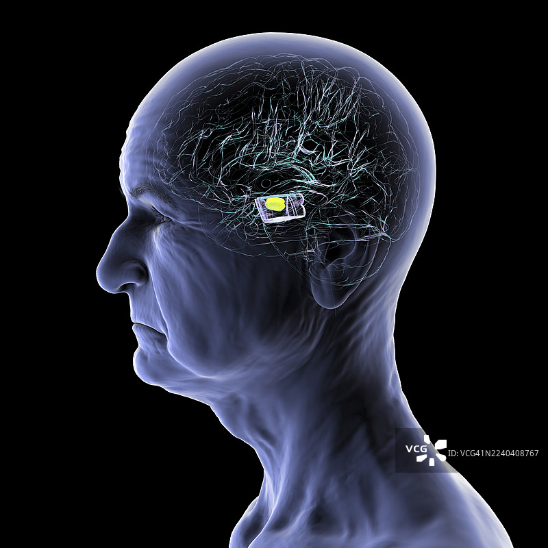 帕金森病变性黑质，插画图片素材