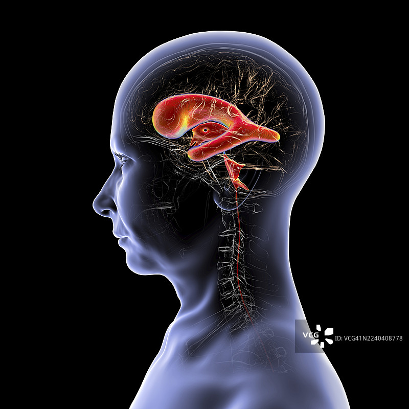 正常压力脑积水，插画图片素材