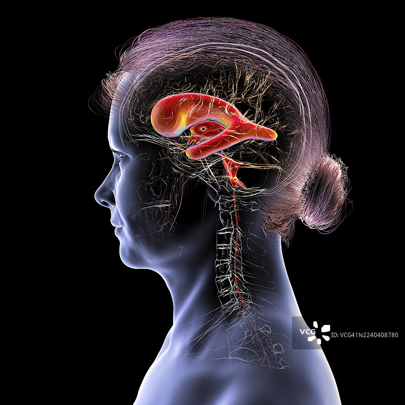 正常压力脑积水，插画图片素材