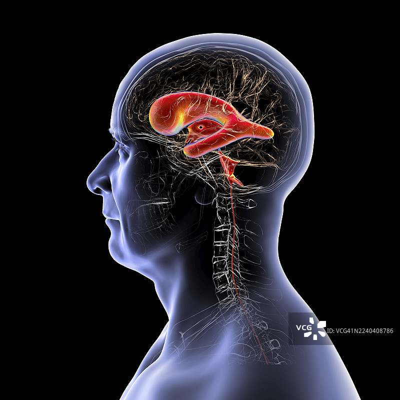 正常压力脑积水，插画图片素材