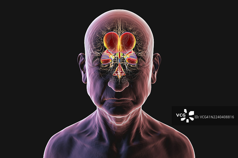 正常压力脑积水，插画图片素材