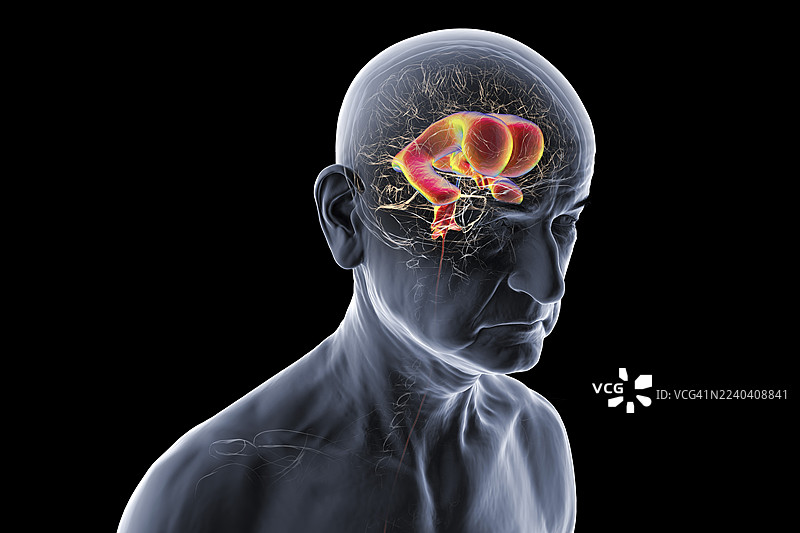 正常压力脑积水，插画图片素材