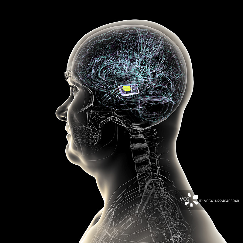 帕金森氏症的退化性黑质，插画图片素材