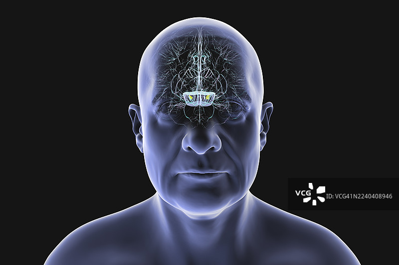 帕金森病中变性的黑质，插画图片素材