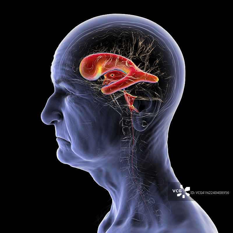 正常压力脑积水，插画图片素材