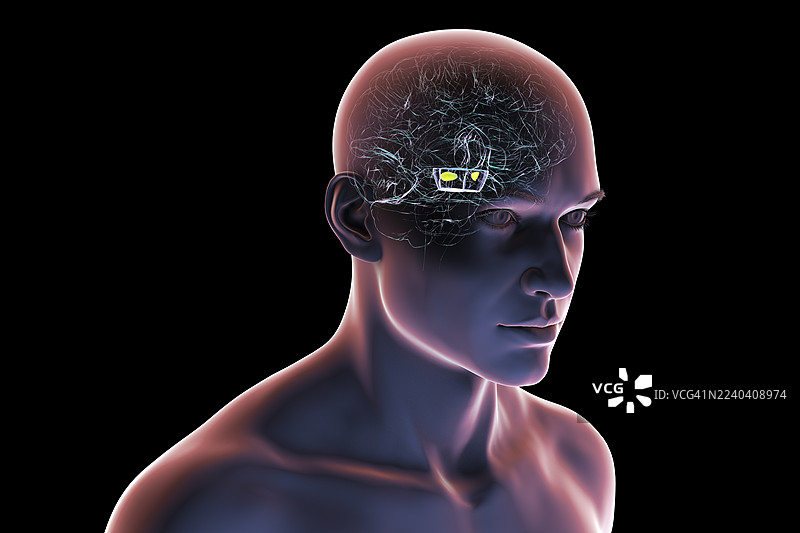 帕金森病中退化的黑质，插画图片素材