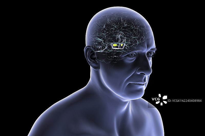 帕金森病中退化的黑质，插画图片素材