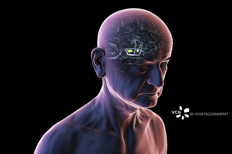 帕金森病变性黑质，插画图片素材