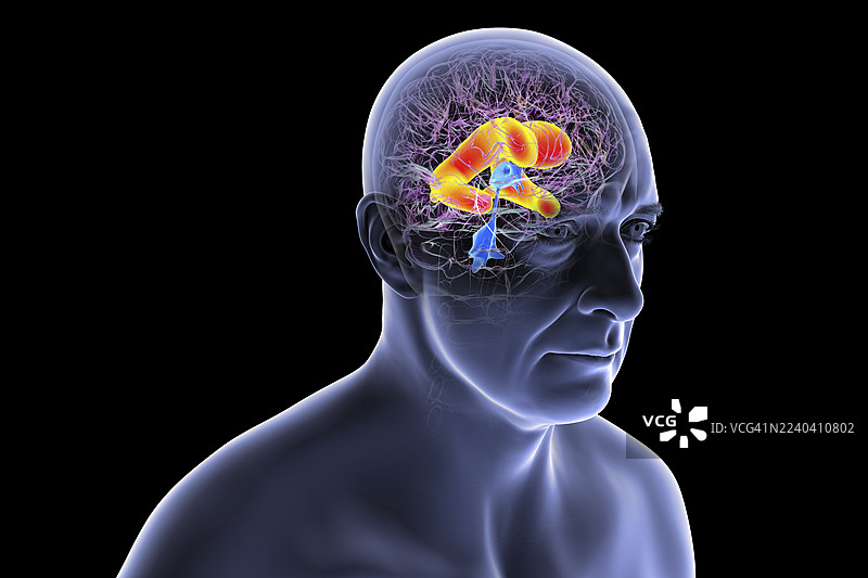 脑室增大的大脑，插画图片素材