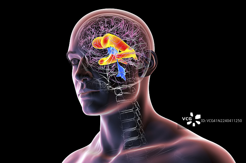 脑室扩大的人脑，插画图片素材