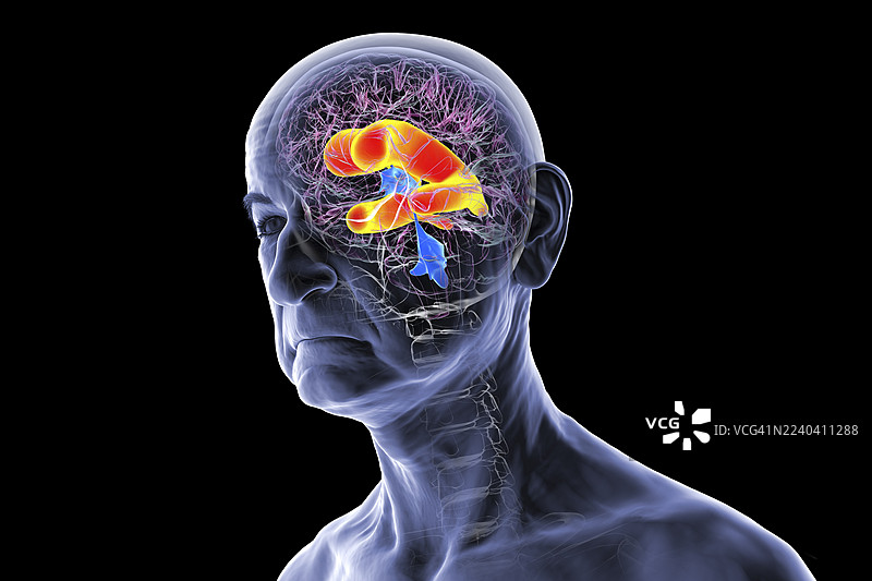 脑室扩大的人脑，插画图片素材