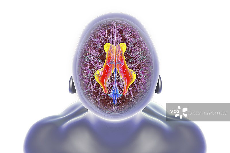 脑室增大的脑部，插画图片素材