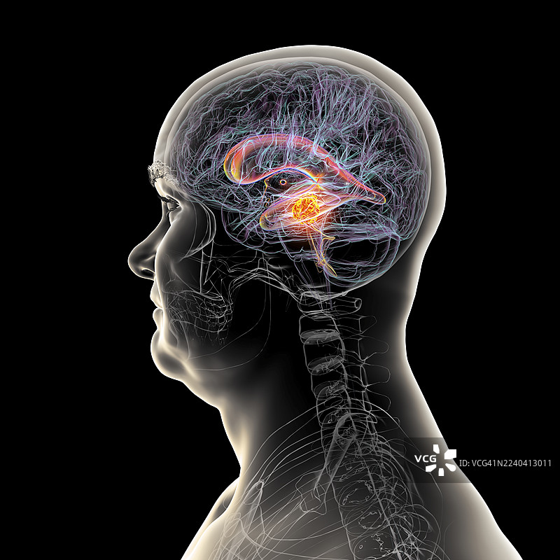 脑肿瘤引起脑积水，插画图片素材