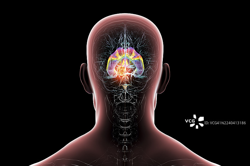 脑肿瘤导致脑积水，插画图片素材